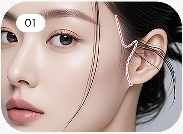 모델 옆얼굴 — 헤어라인 안쪽·귀 앞 절개선(분홍 점선)