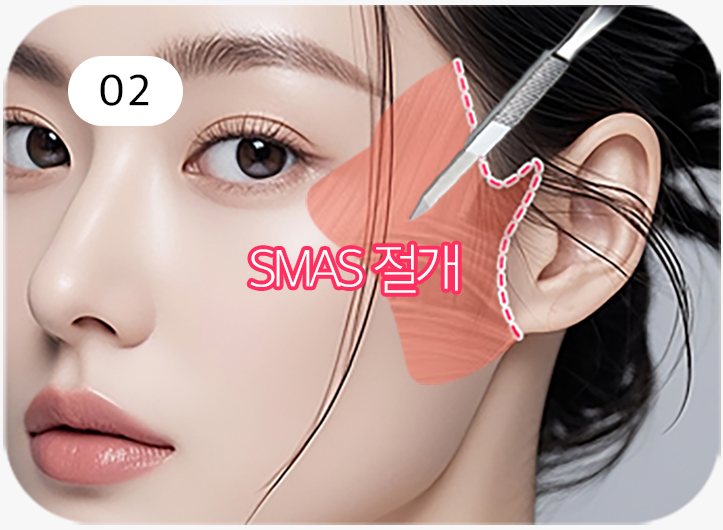 모델 옆얼굴 — 귀 앞 SMAS 절개 부위 표시와 메스