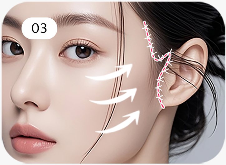 모델 옆얼굴 — 피부·근육을 당기는 방향(흰 화살표)